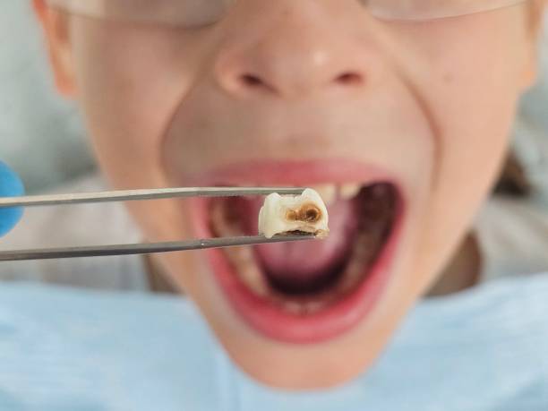 Best Emergency Tooth Extraction in Tunica Resorts, MS